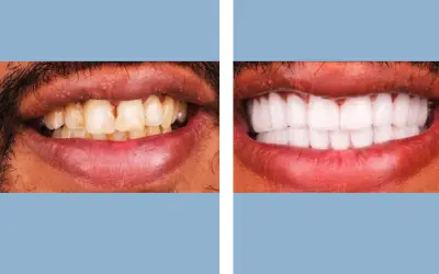 Before and After